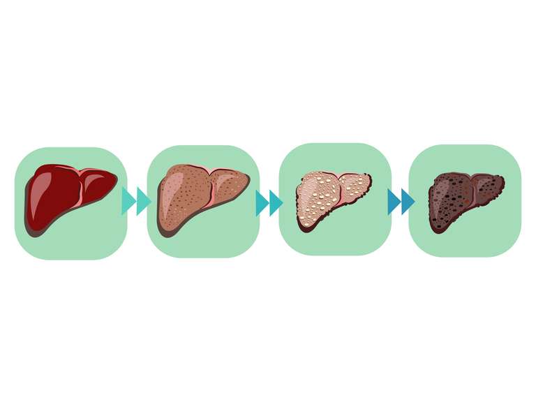 Progression of Cirrhosis 